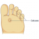 Callus Cure Foot Repair