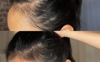 Rediscover Your Confidence at Noida’s Most Recommended Herbal Hair Clinic