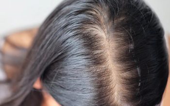 Holistic Alopecia Areata Treatment in Noida at Alopecia Herbal Treatment